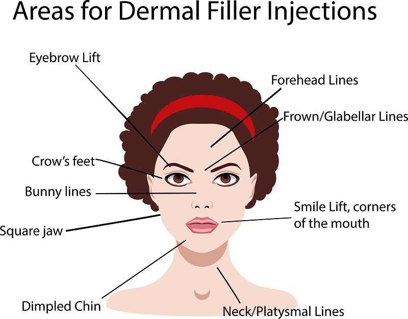 Dermal Filler Injections
